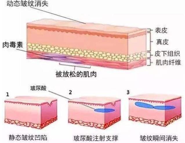 透明质酸玻尿酸除皱原理图