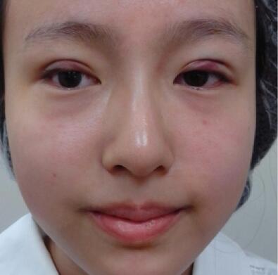 看我在萍乡丽芙整形医院做的埋线双眼皮，果图！