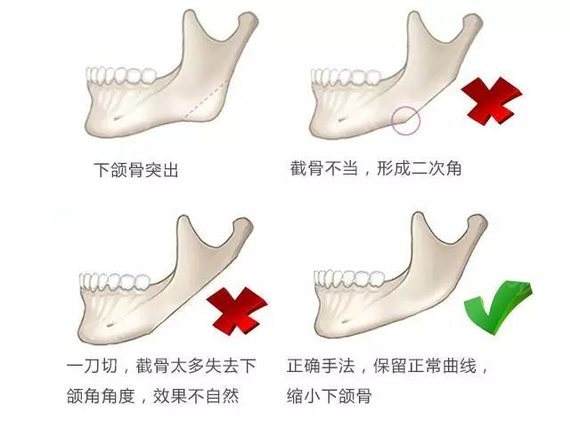 2年前做完下颌骨截骨手术，现如今来给大伙儿科学普及一下下！