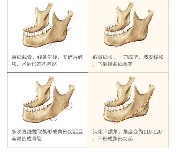 2年前做完下颌骨截骨手术，现如今来给大伙儿科学普及一下下！