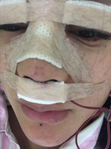讲一讲我到广州紫馨美容医院做耳软骨隆鼻亲身经历|案例图