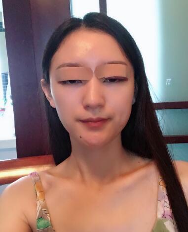 飞到韩国做医美，韩辰整形医院全切双眼皮典型案例反馈！