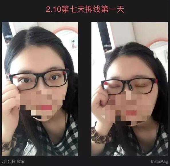 上海九院美容科双眼皮案例