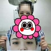 重庆西南医院刘林奇双眼皮案例，妹子投稿分享啦！