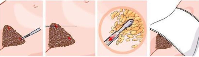 腹腰吸脂手术操作步骤