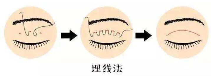 埋线法双眼皮手术操作步骤原理图