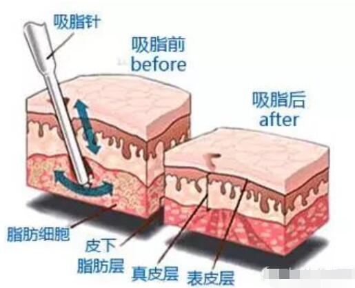 吸脂手术的原理图