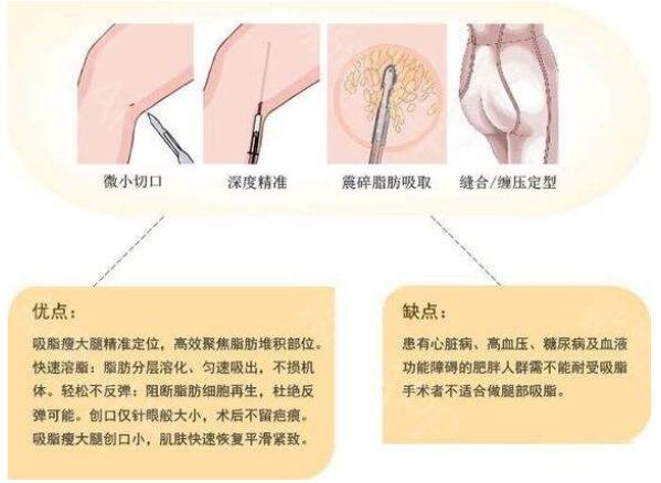 大腿吸脂手术优缺点