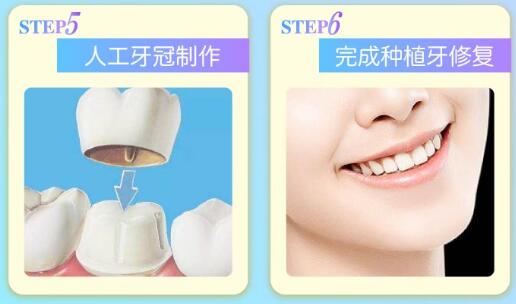 2020年上海市种植牙价格表收费标准详细信息一览