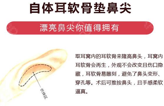 鼻头成形术