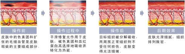 专业彩光嫩肤祛斑做几次才有？容易反弹吗？