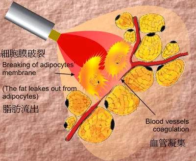 激光溶脂多少钱？听说它创伤小、恢复快