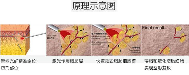 大象腿快看！激光溶脂瘦腿术咱们一起来了解一下