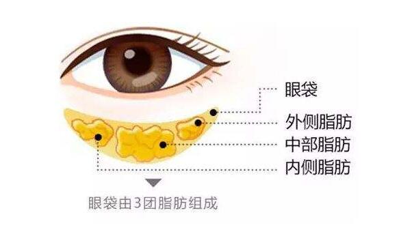 去眼袋手术图片：不同的调节方式对应解决的眼袋类型不一样！