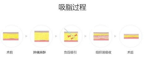 腰部吸脂手术的过程