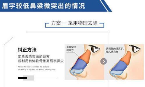 驼峰鼻修复知识全科普，来看看适合你吗？