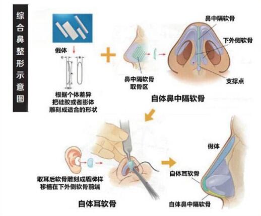 硅胶隆鼻整形术容易透光？这点你介意吗