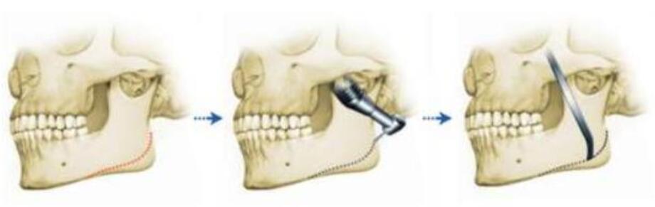 下颌角磨骨手术的步骤图