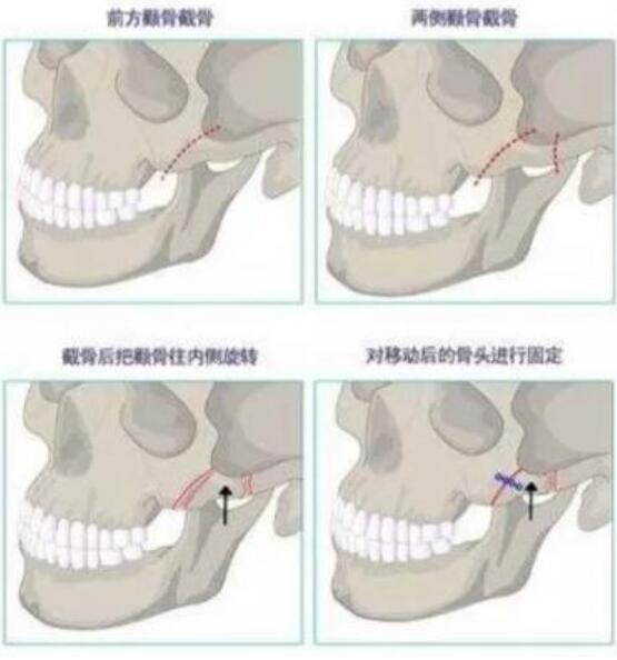 颧骨内推手术的恢复期