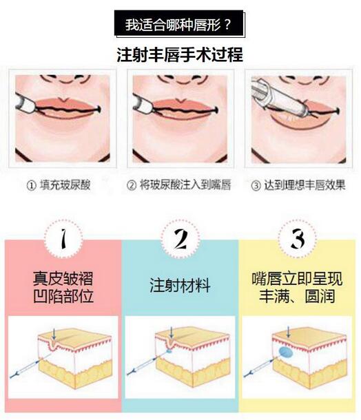 注射丰嘴唇