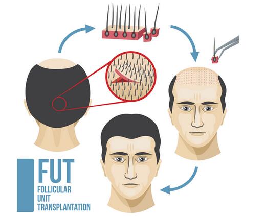 FUT植发过程图