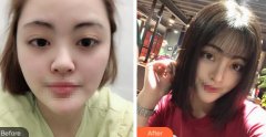 【案例】上海鲁南做鼻部手术怎么样？历时2个月终于恢复漂亮了