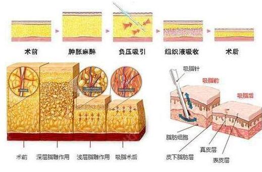 腿部吸脂手术原理