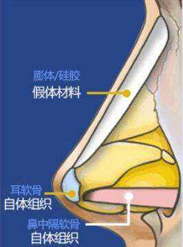 假体隆鼻手术没问题吗？术前详细了解少走弯路