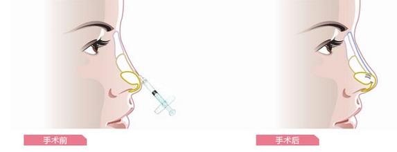 鼻子注射玻尿酸的间隔时间多长才好？