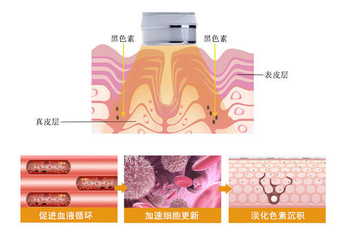 做光子嫩肤美容真的能提升肤质吗？看看果图