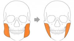 下颌角太肥？咬肌切除手术说不定就能搞定