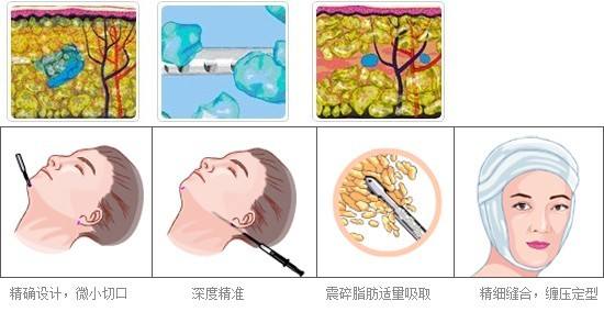 下颌角太肥？咬肌切除手术说不定就能搞定