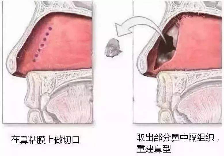 这3种自体软骨移植隆鼻术，肋骨、耳软骨、鼻中隔如何选