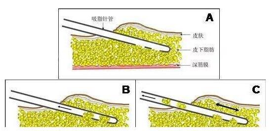 什么是腹部吸脂手术?