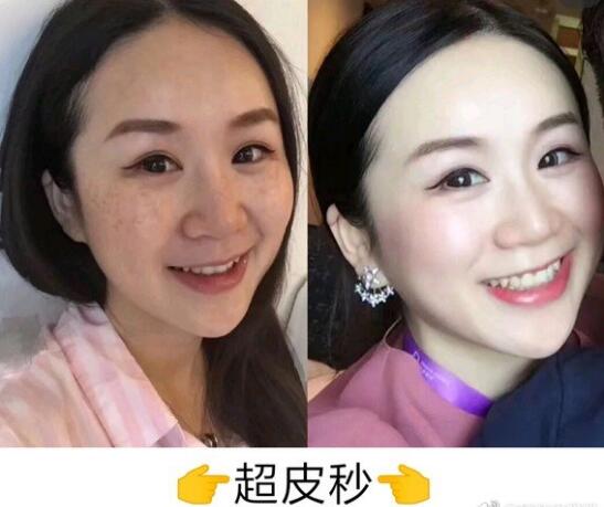 汉中3201医院整形美容科激光祛斑果图 案例