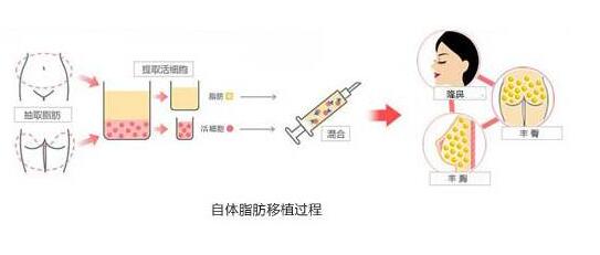 关于自体脂肪填充卧蚕脂肪的成活率：