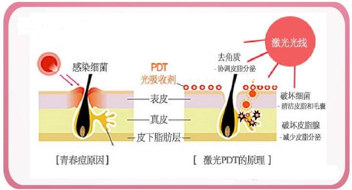 怎样去除青春痘疤痕有又彻底？赶走痘痘肌~