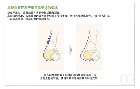 术前了解一下：驼峰鼻整形费用大概多少钱？