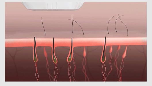 光子脱毛的危害