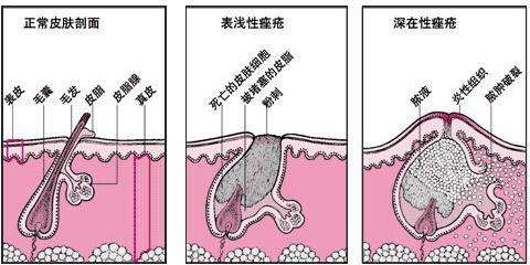 光子调节痤疮需要几次？术后注意事项