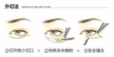 盘点一下抽脂去眼袋费用 果和维持时间