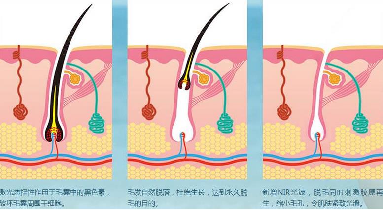 额头激光脱毛的原理