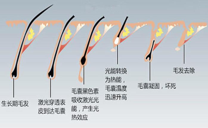 额头激光脱毛的原理，毛发的生长周期