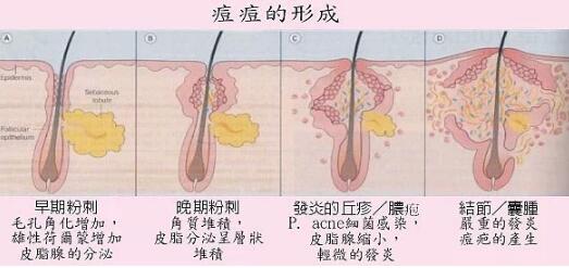 长痘的原因