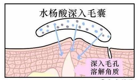 水杨酸祛痘优点