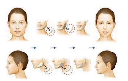 男性过大下颌角整形手术果怎么样？有图有真相！