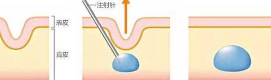 注射胶原蛋作用介绍：