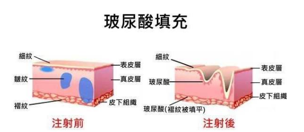 注射玻尿酸有什么副作用