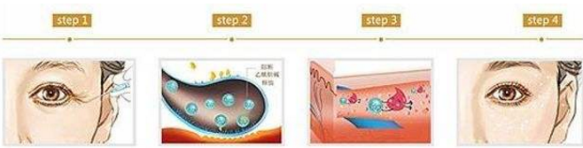 眼角皱纹除皱你以为保养品就能解决？还得靠医美~