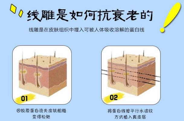 埋线提升除皱避坑详细攻略